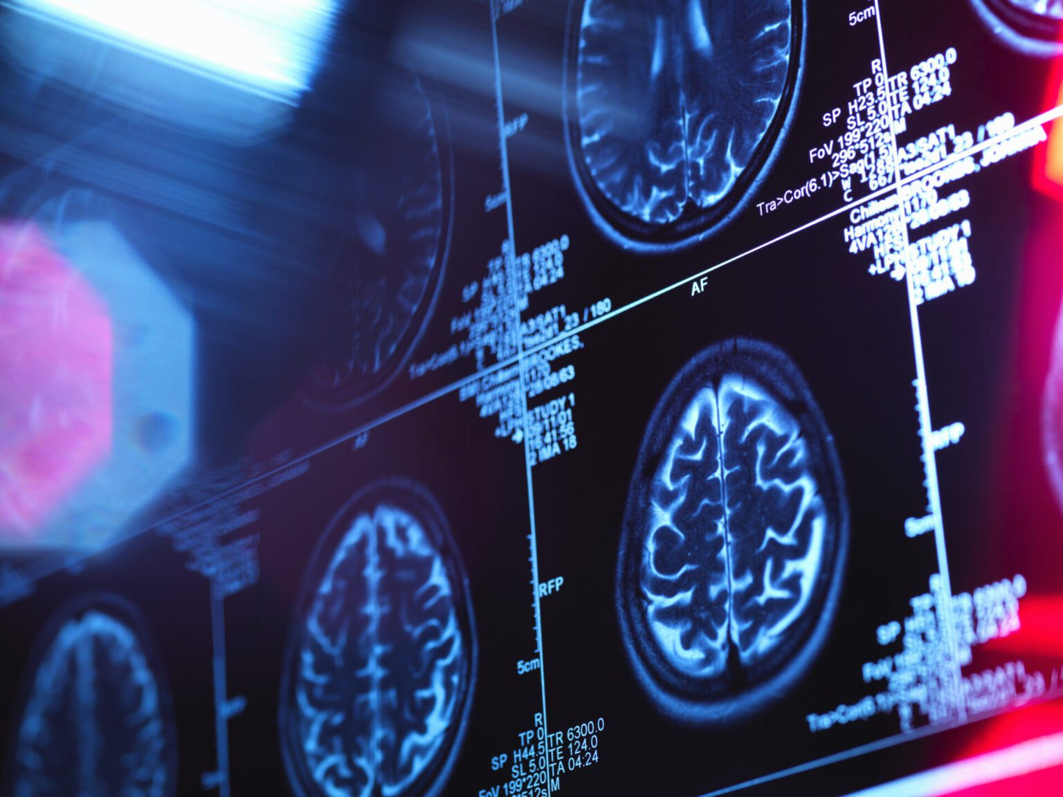 Image of several brain scans on a computer screen